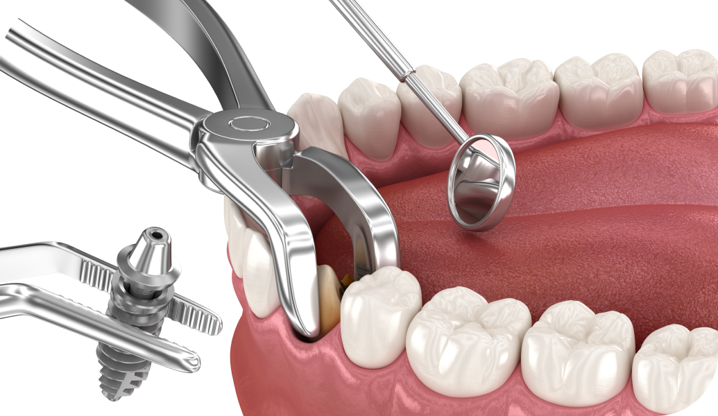 https://peyraverney.mediweb.co/wp-content/uploads/2025/08/extraction-implantation-art-dental-concept.webp
